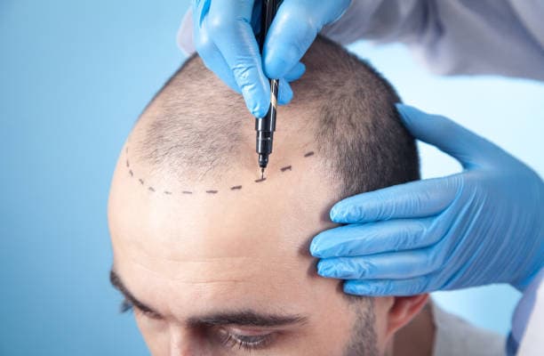 How Much Does Hair Transplant Cost: Full Treatment Breakdown