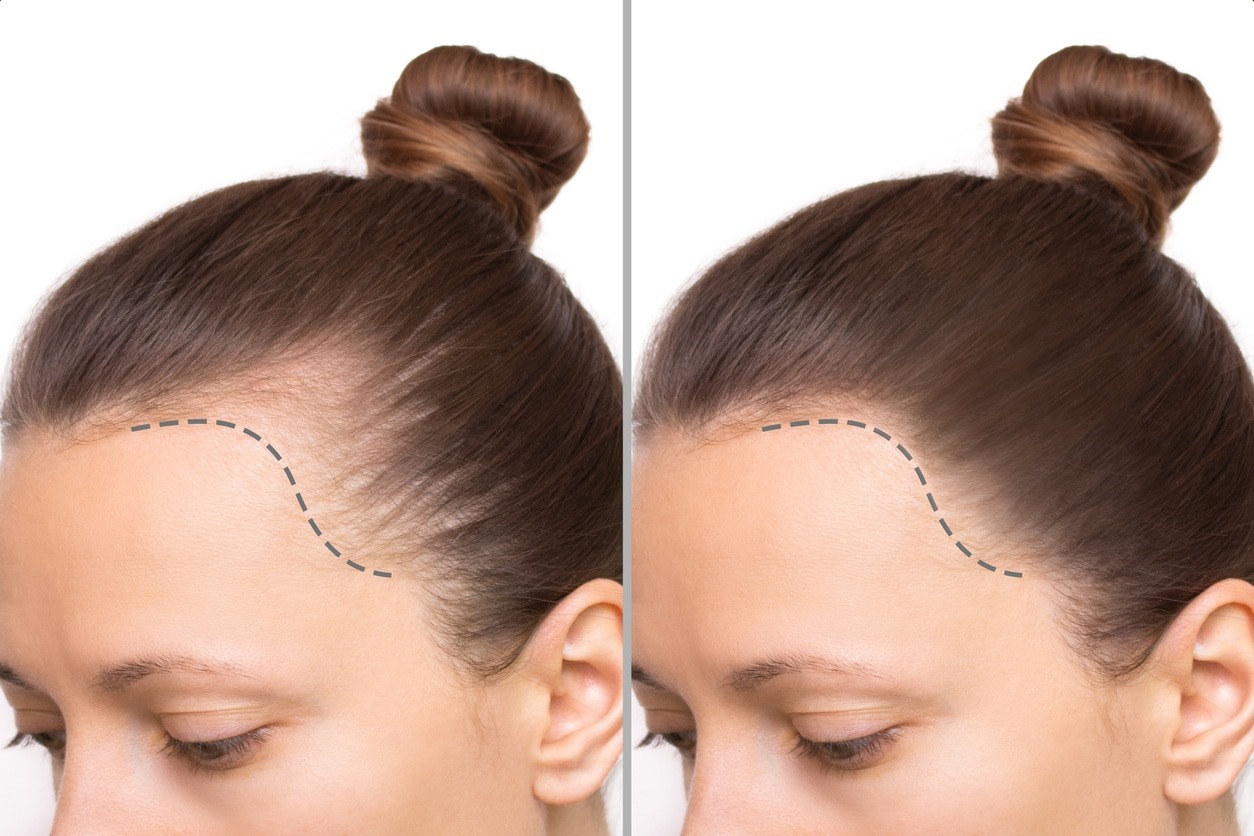 Hair Transplant London for Men – Regain Confidence Naturally