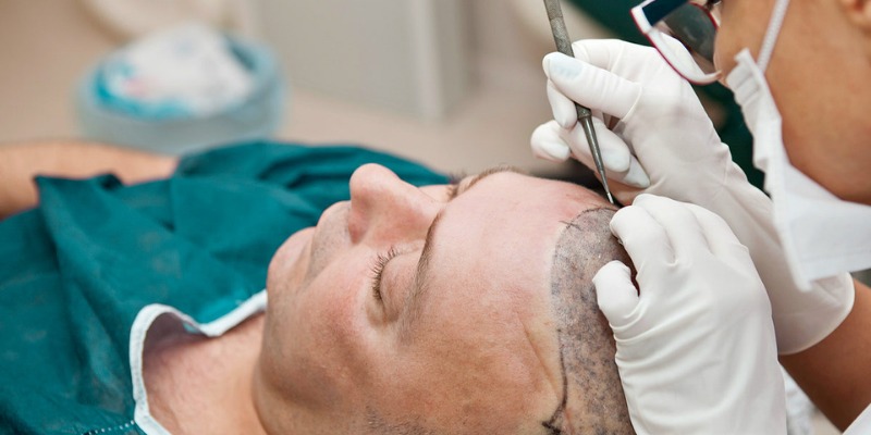Sapphire Hair Clinic Hair Transplant Turkey for Natural Growth